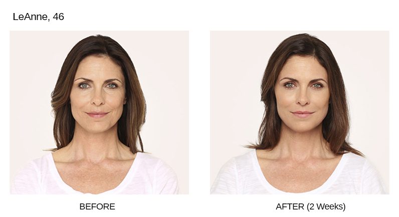 Radiesse Before & After