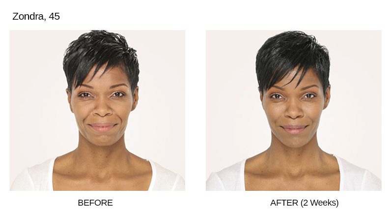 Radiesse Before & After