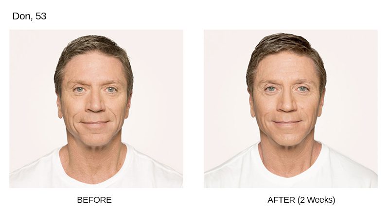 Radiesse Before & After