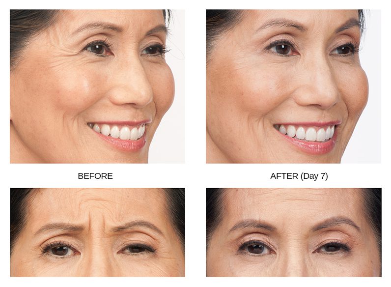 Botox Before & After Image