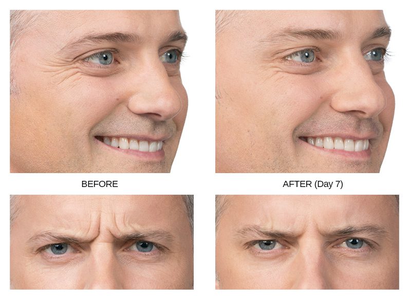 Botox Before & After Image