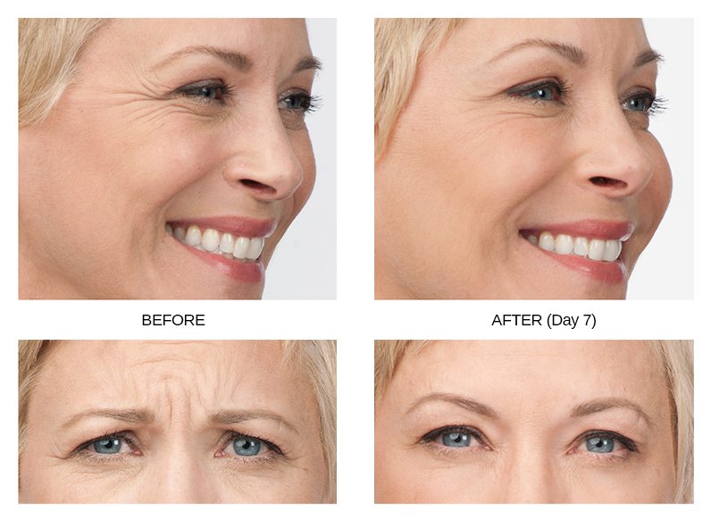 Botox Before & After Image