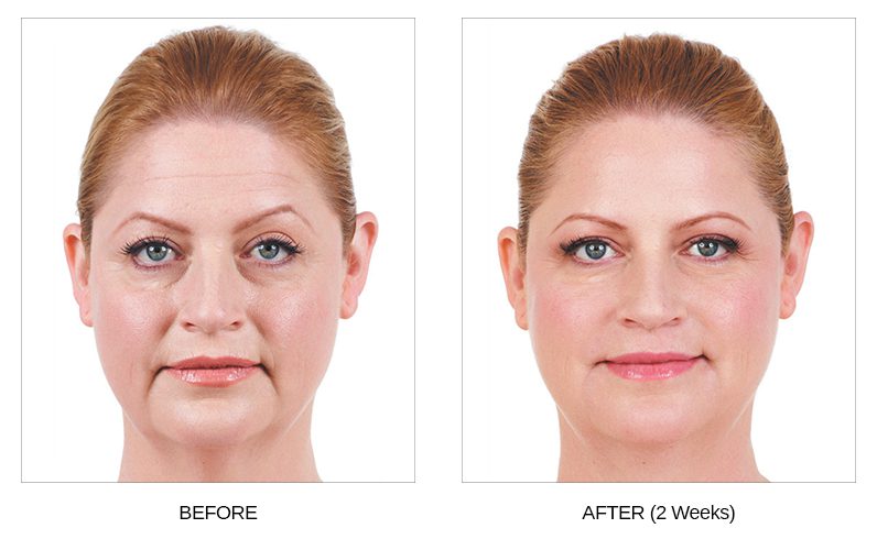 Juvederm Before & After Photos