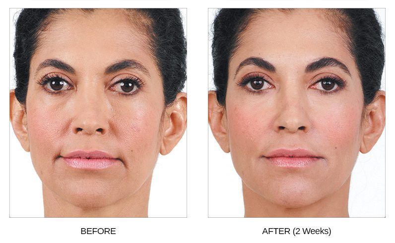 Juvederm Before & After Photos