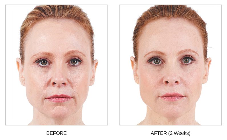 Juvederm Before & After Photos