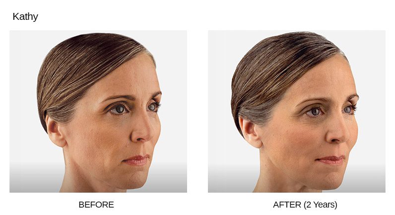 Voluma Before & After Photos